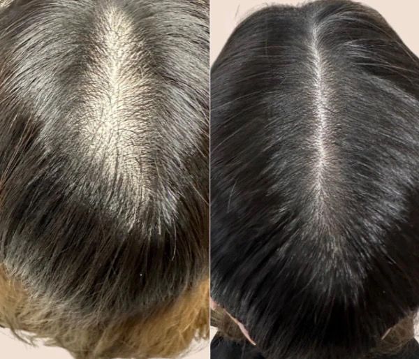 Zelltra™ Red Light Therapy Hair Reviver Device