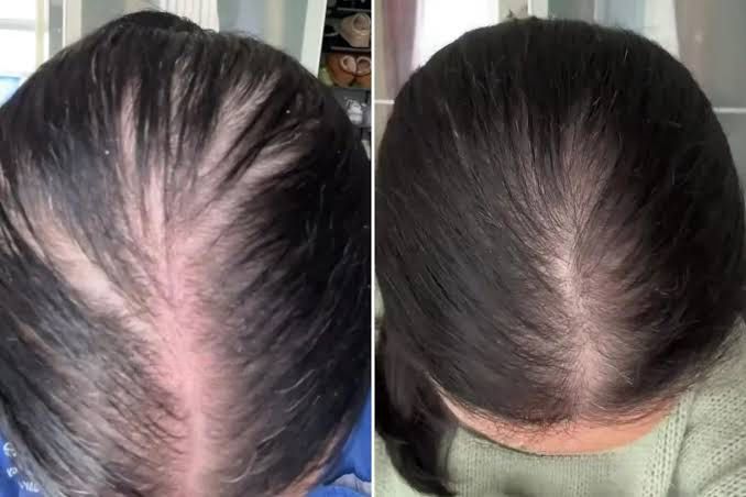 Zelltra™ Red Light Therapy Hair Reviver Device